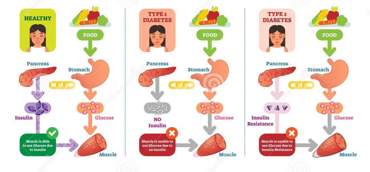 types-diabetes-simple-medical-vector-illustration-scheme-health-care-information-diagram-types-diabetes-simple-medical-115835865