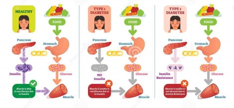 types-diabetes-simple-medical-vector-illustration-scheme-health-care-information-diagram-types-diabetes-simple-medical-115835865